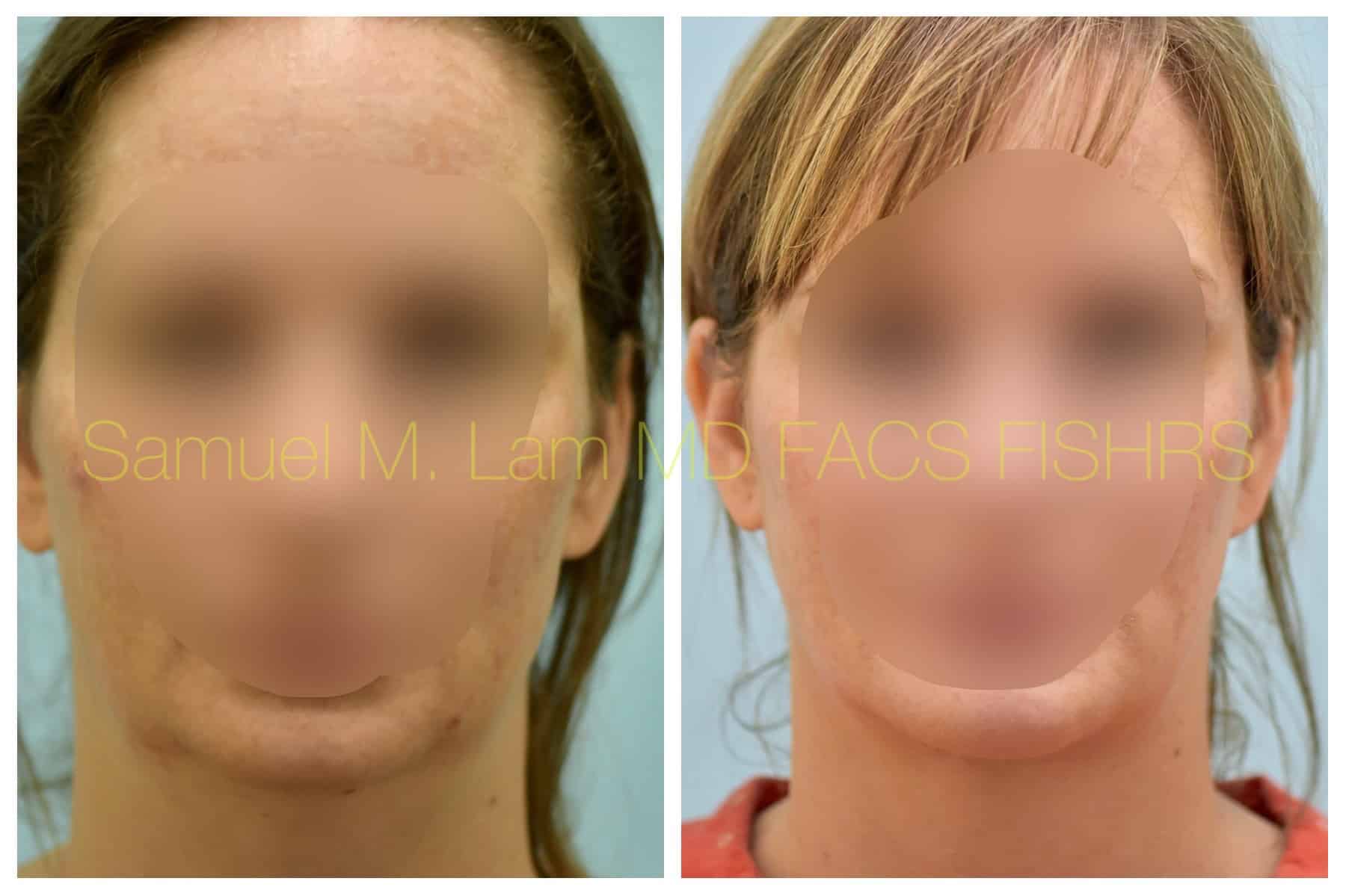 Facelift before and after