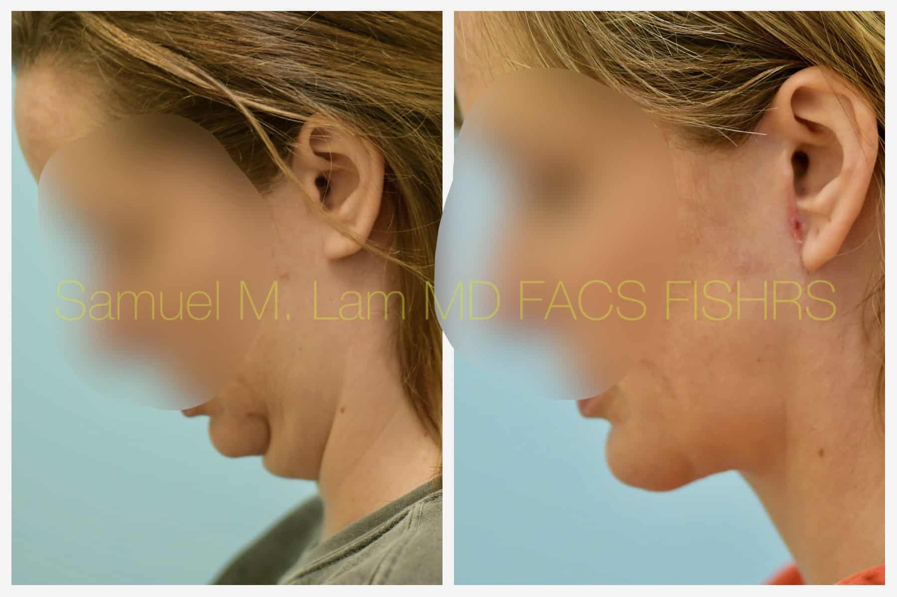 Facelift before and after