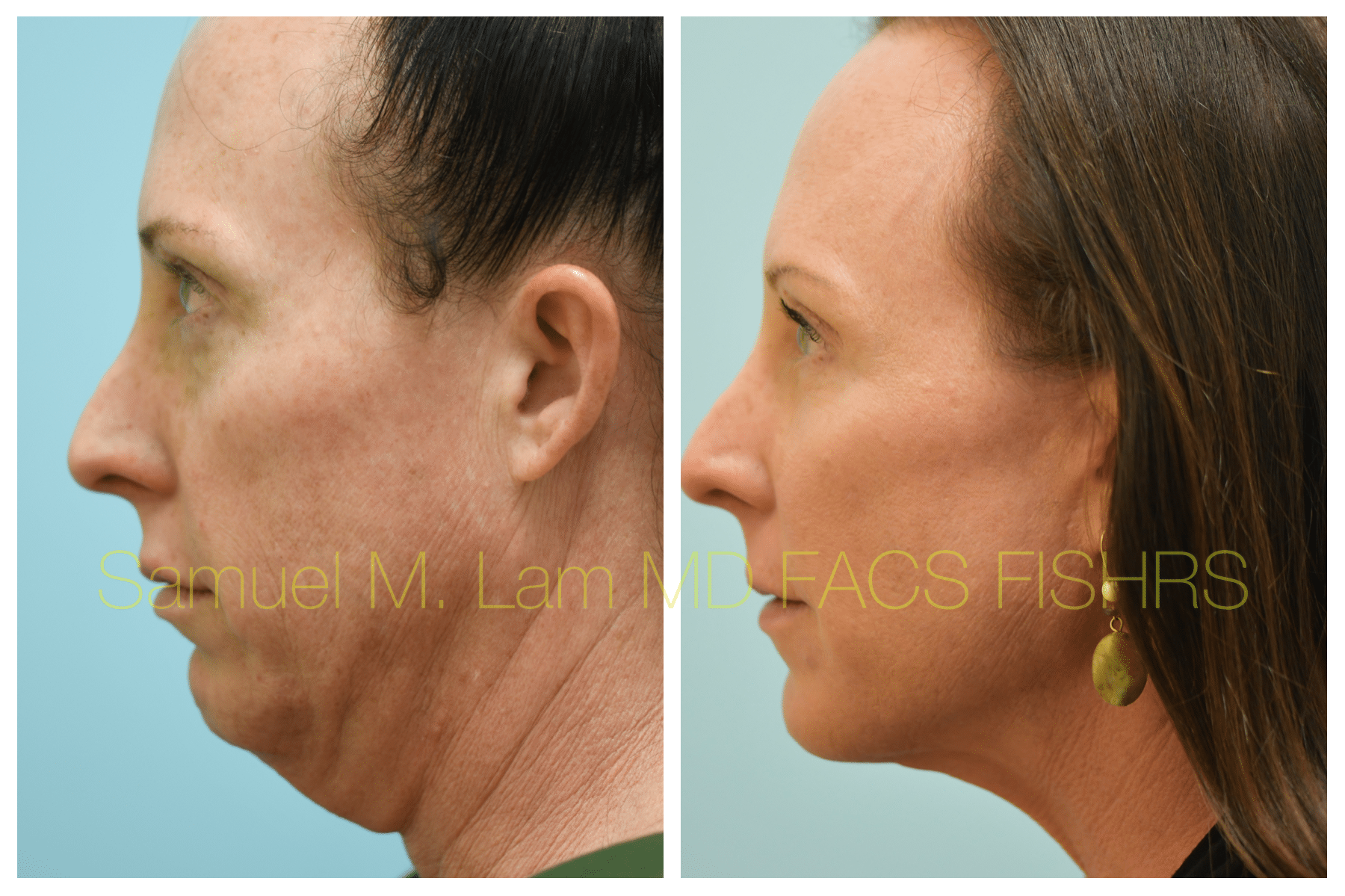 Facelift before and after