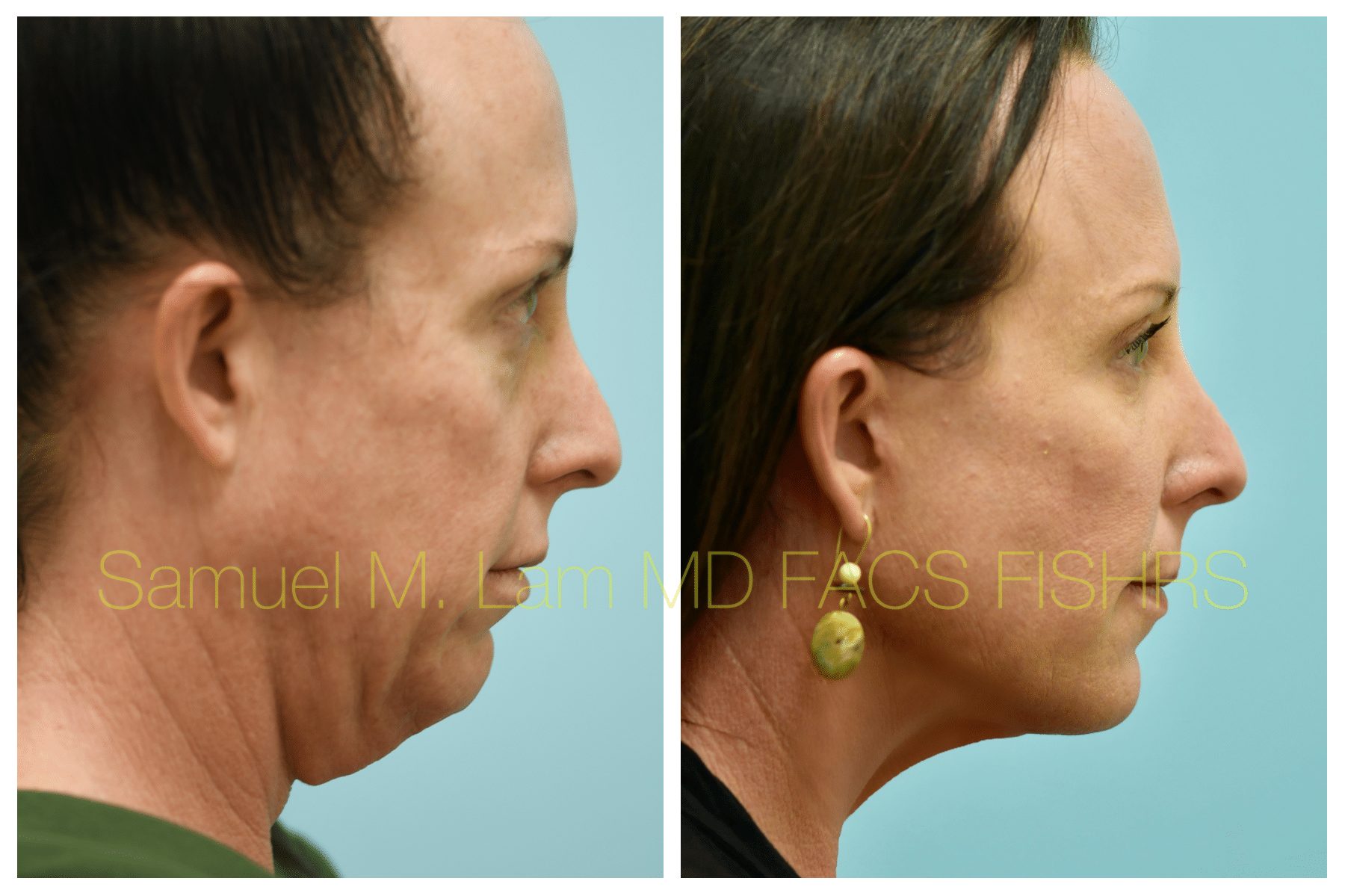 Facelift before and after