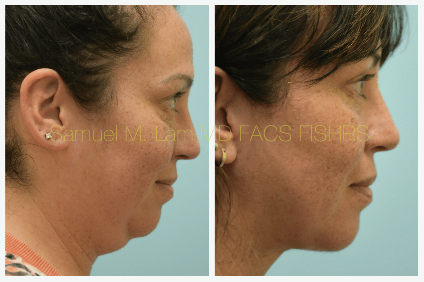 Facelift before and after