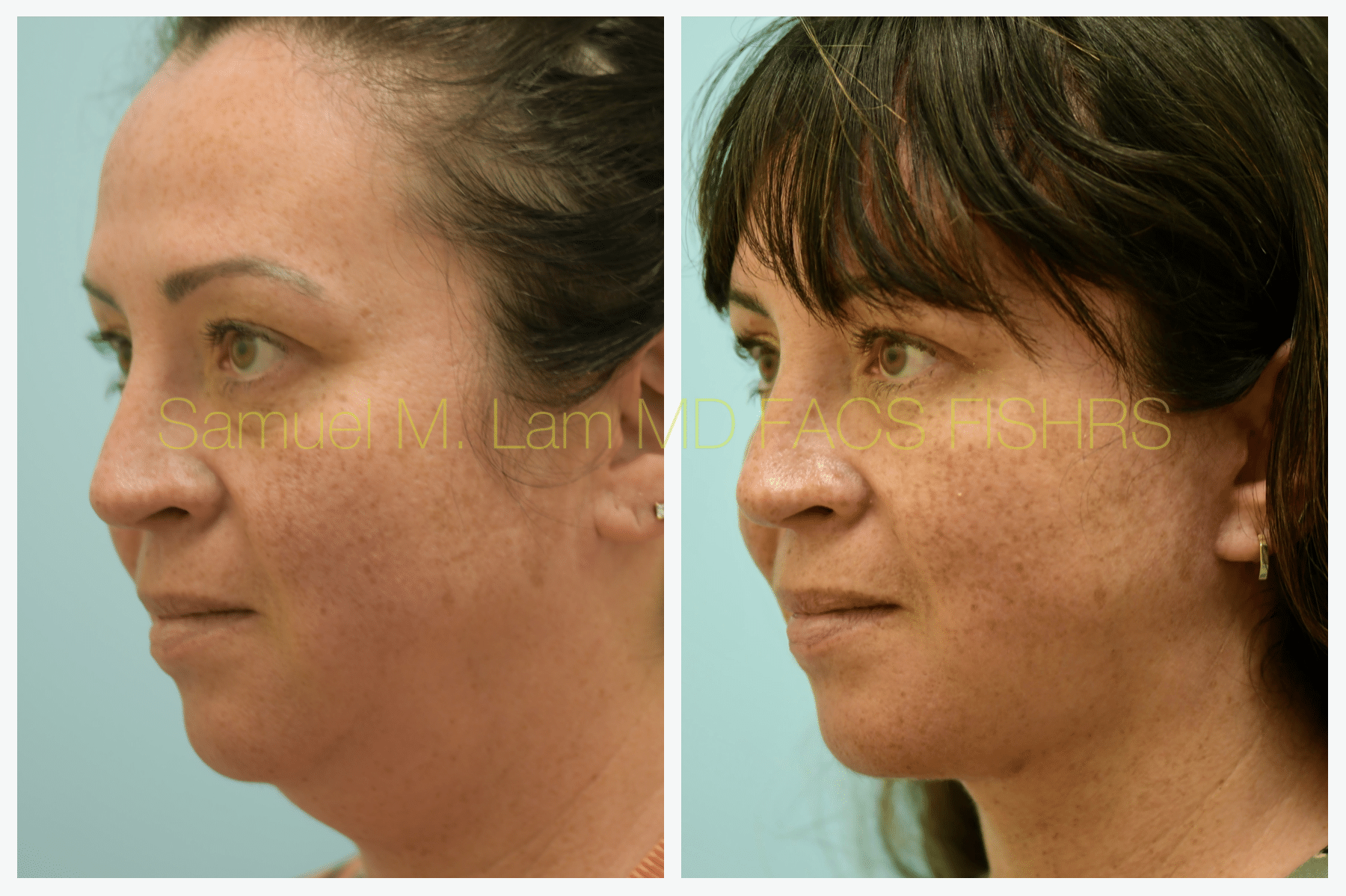 Facelift before and after