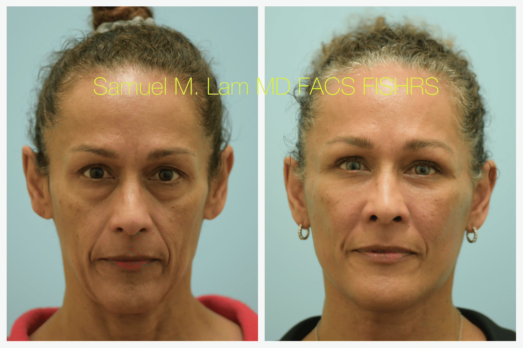 Facelift before and after