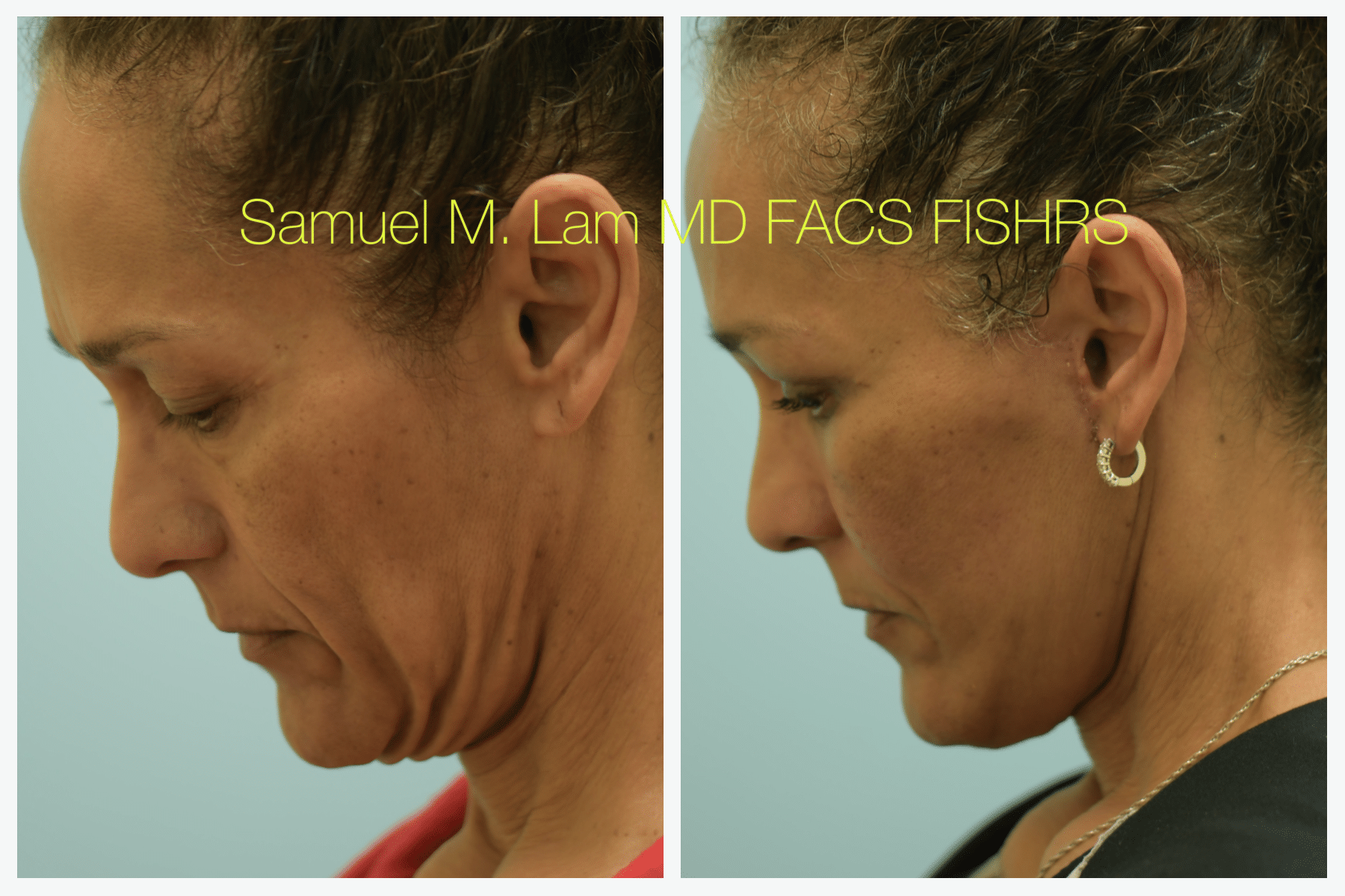 Facelift before and after