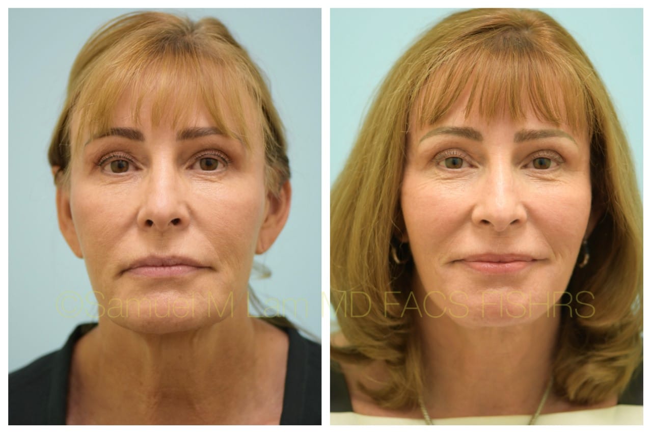 Facelift before and after