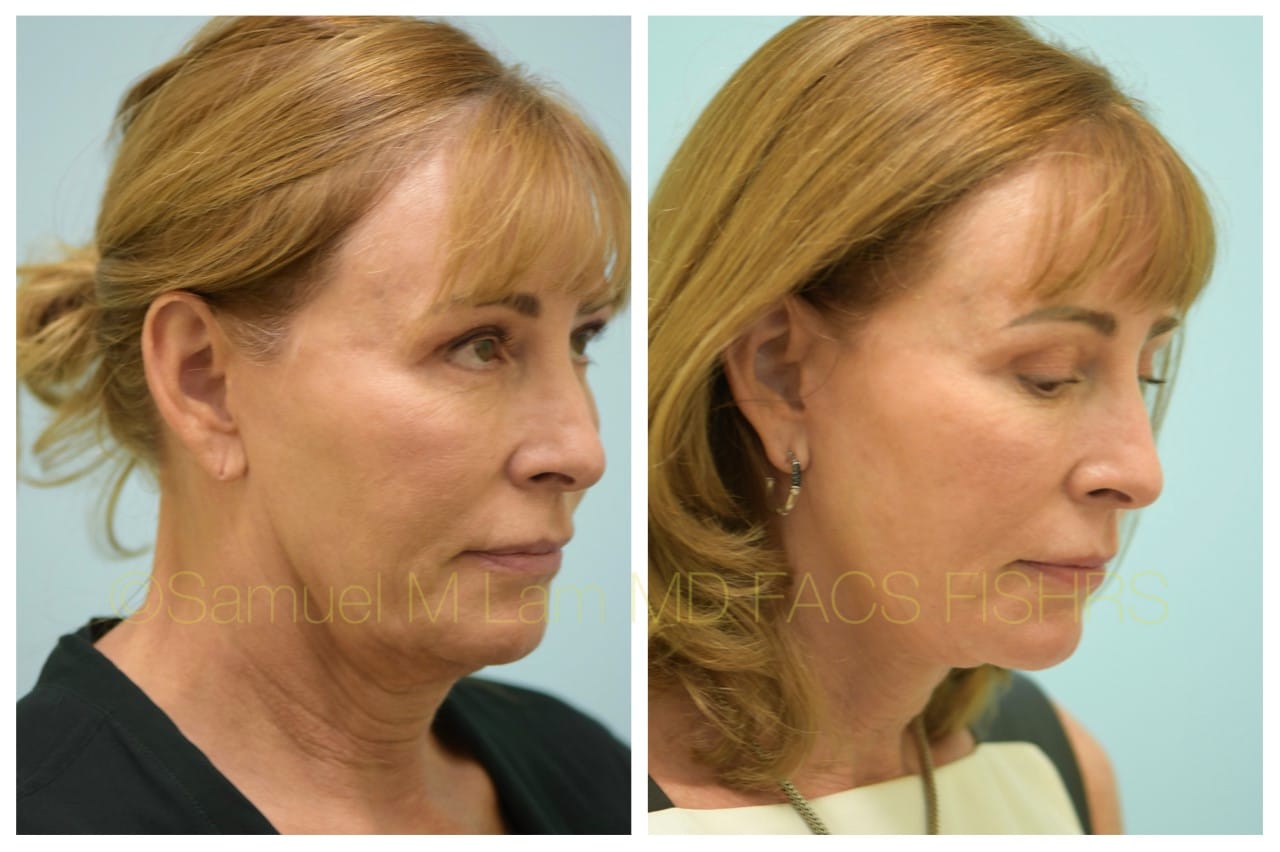 Facelift before and after