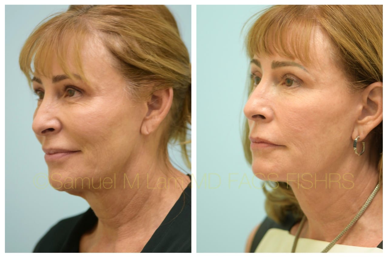 Facelift before and after