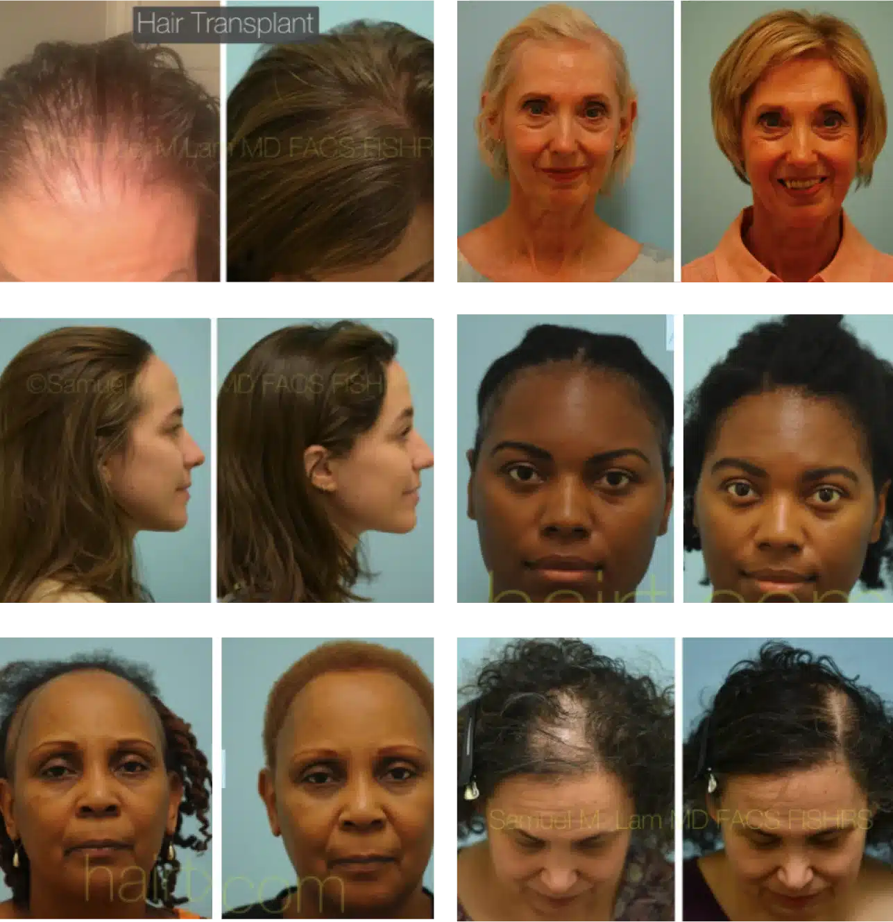 FUE hair restoration before and after