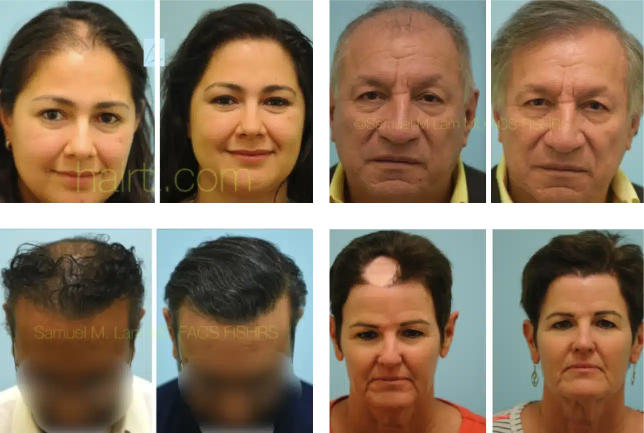 FUE hair restoration before and after