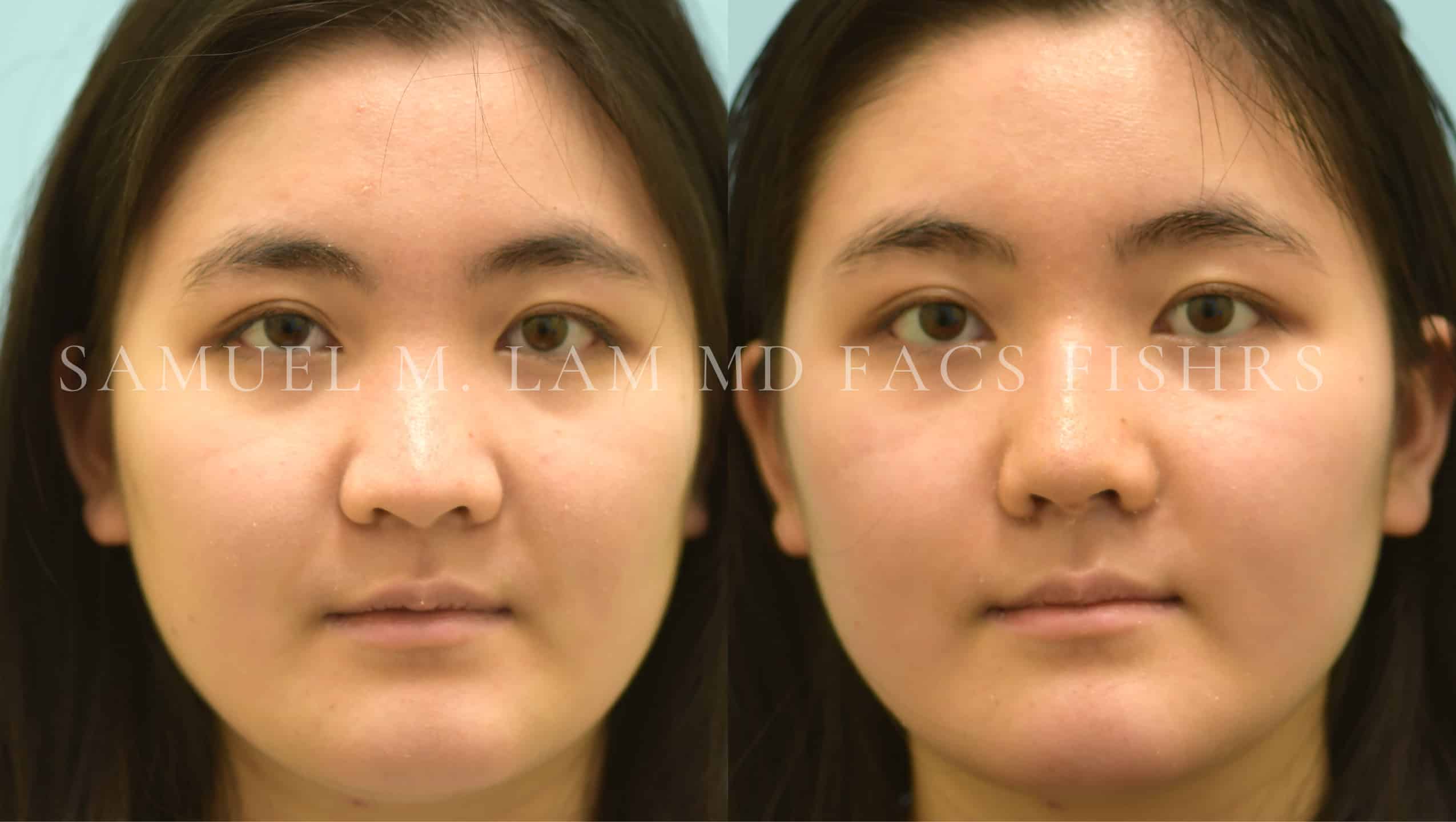 Rhinoplasty before and after photo by Dr. Lam
