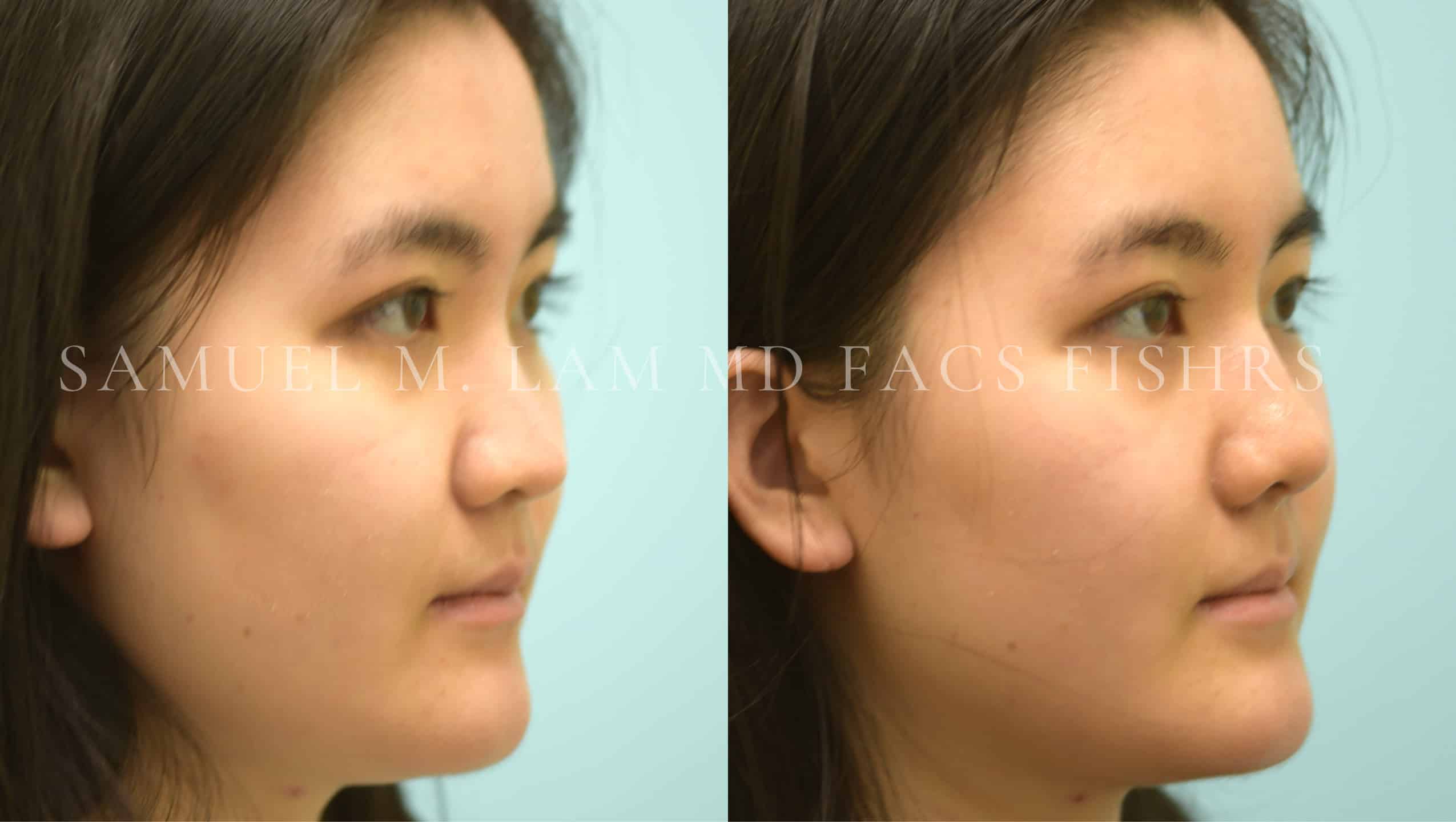 Rhinoplasty before and after