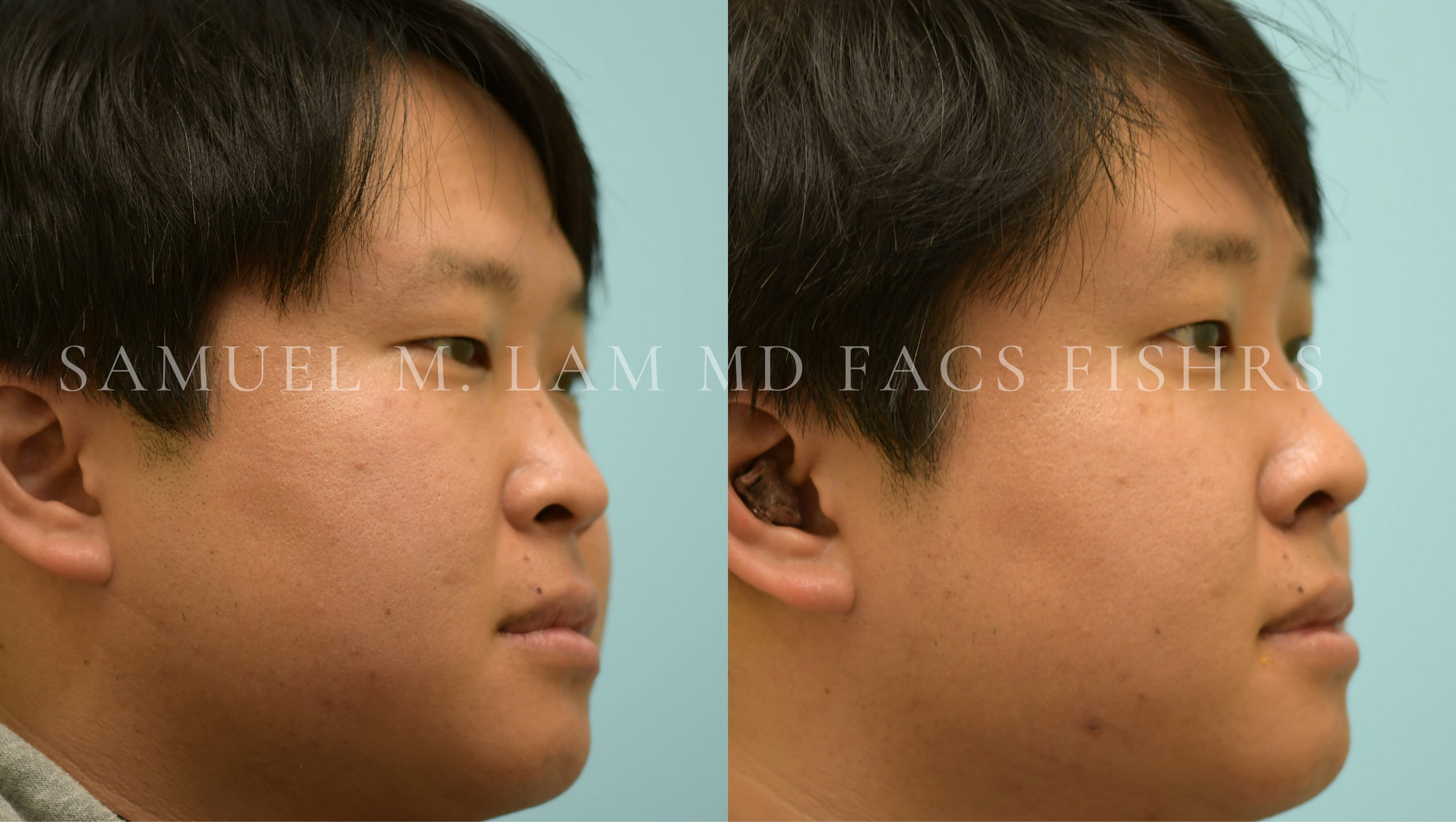 Rhinoplasty before and after