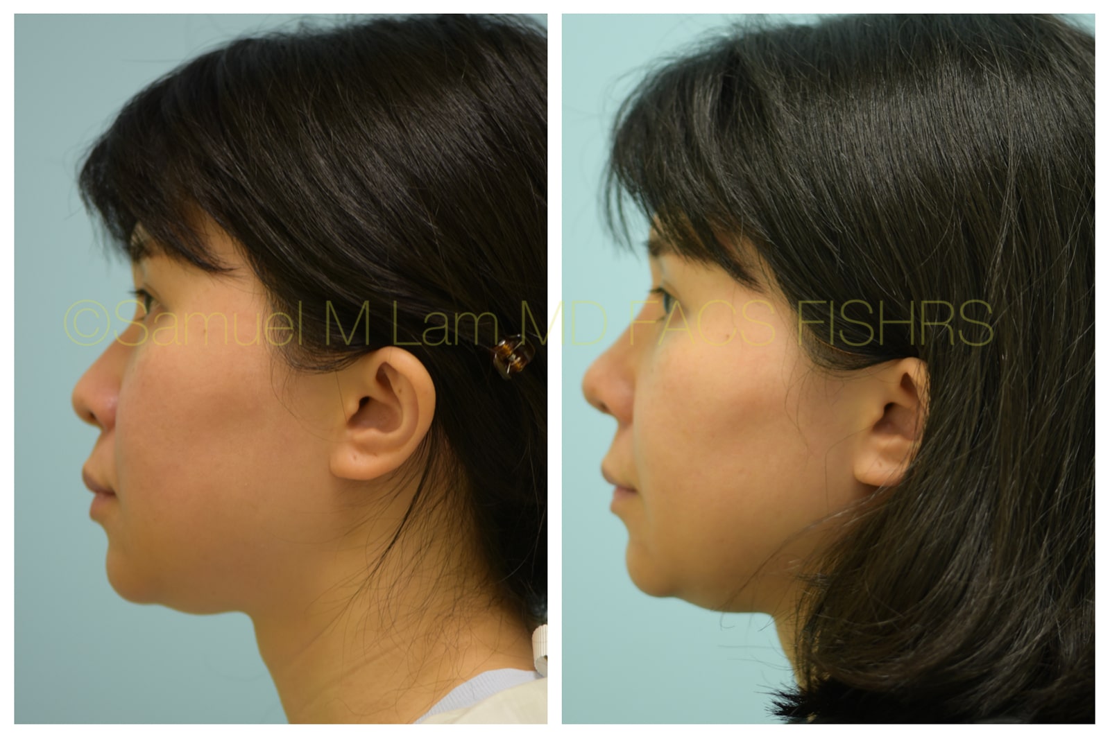 Rhinoplasty before and after