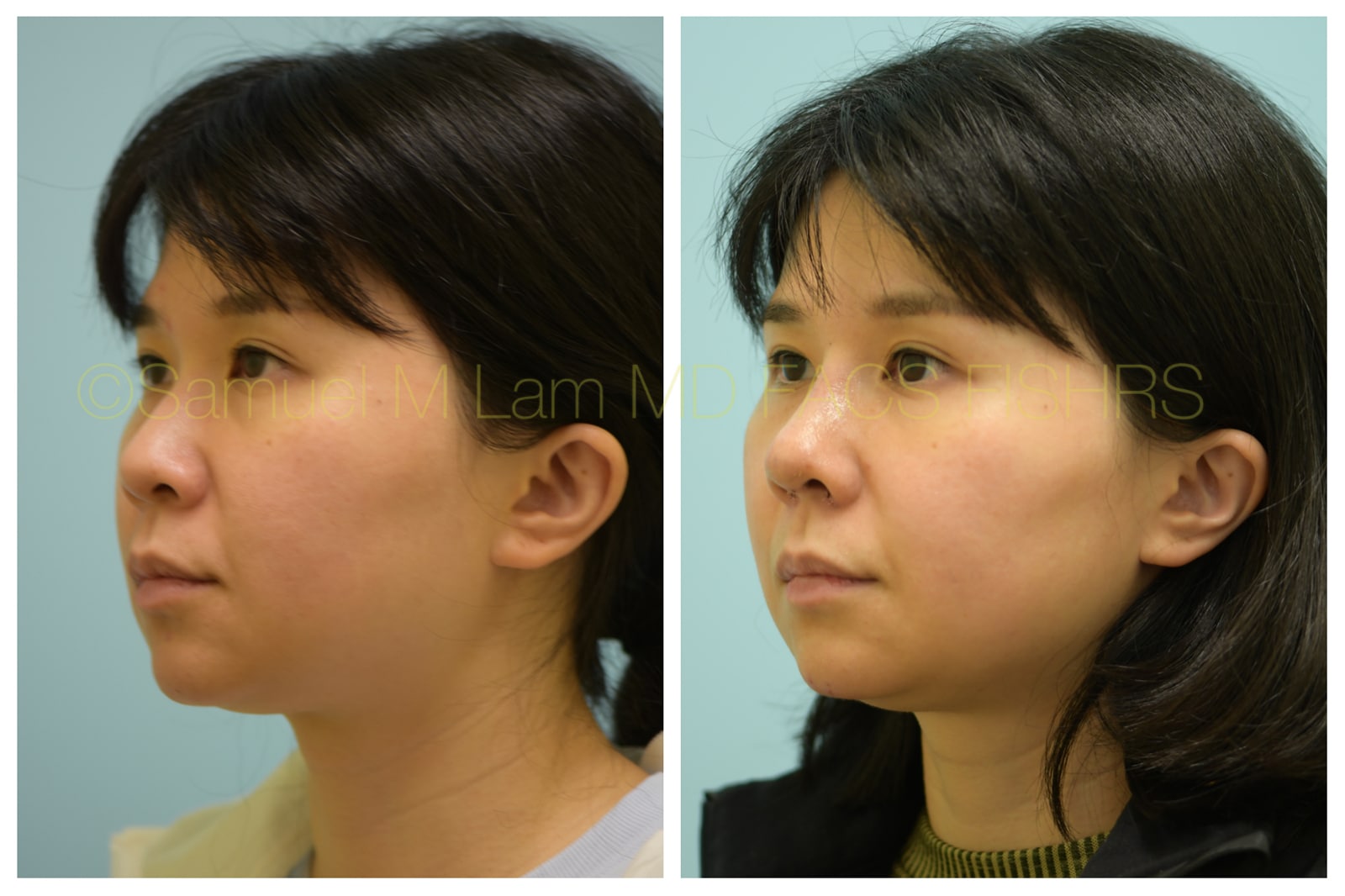 Rhinoplasty before and after
