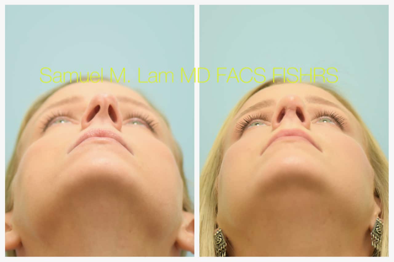 Rhinoplasty before and after