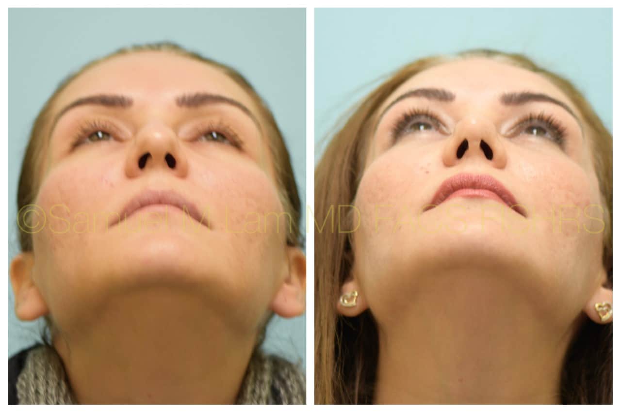 Rhinoplasty before and after