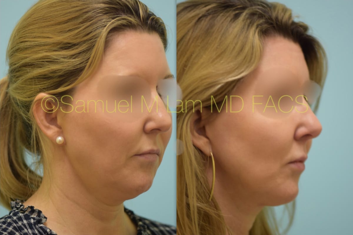 Rhinoplasty before and after