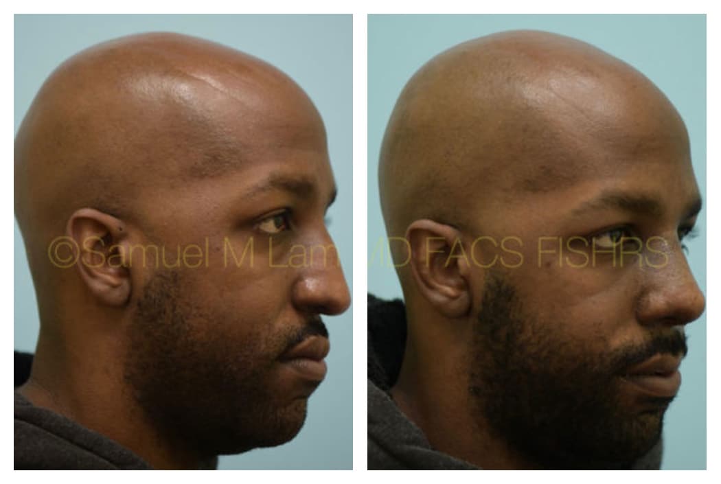 Rhinoplasty before and after