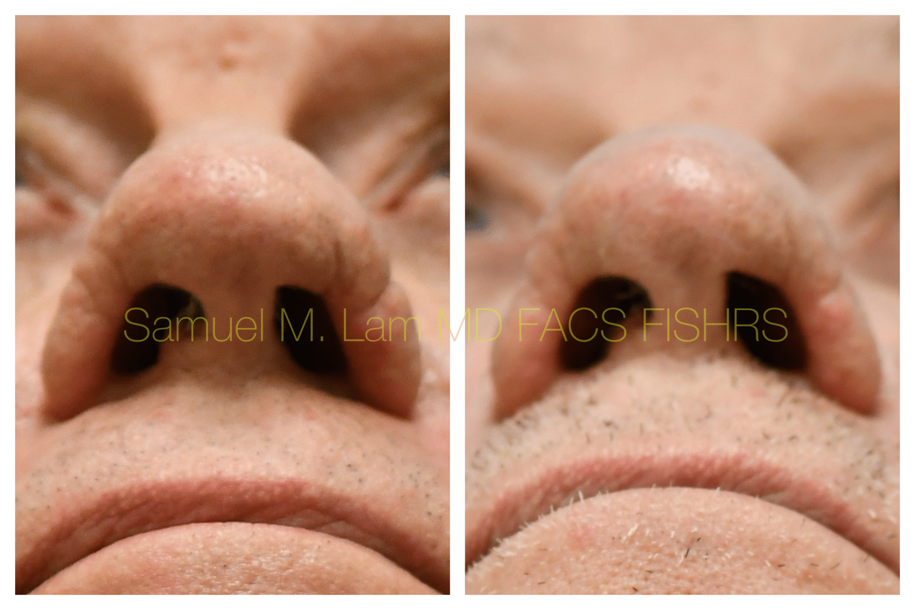 Rhinopyma correction before and after